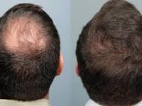 Rejuvenate and Restore: The Lahore Edition of Hair Transplant Excellence